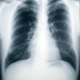 Tuberculosis Screening